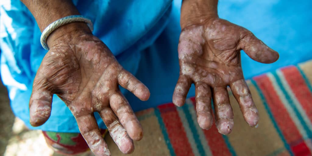 The Laws about Leprosy